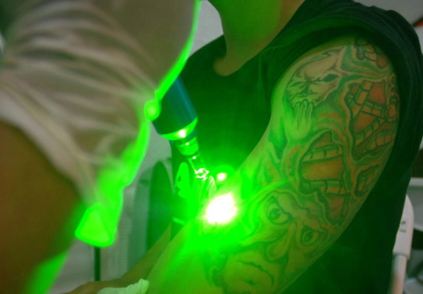 How Does Laser Tattoo Removal Work?: Pain, Effectiveness, Safety