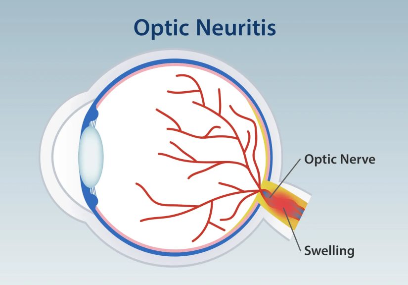 Optic Neuritis: Symptoms, Causes, Tests, Diagnosis, Treatment