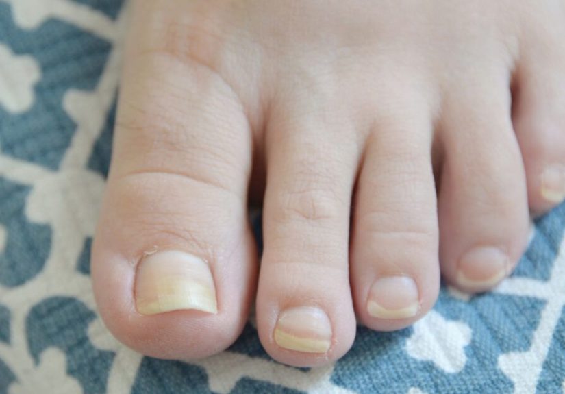 Yellow Toenails: Causes, Prevention, and Treatments