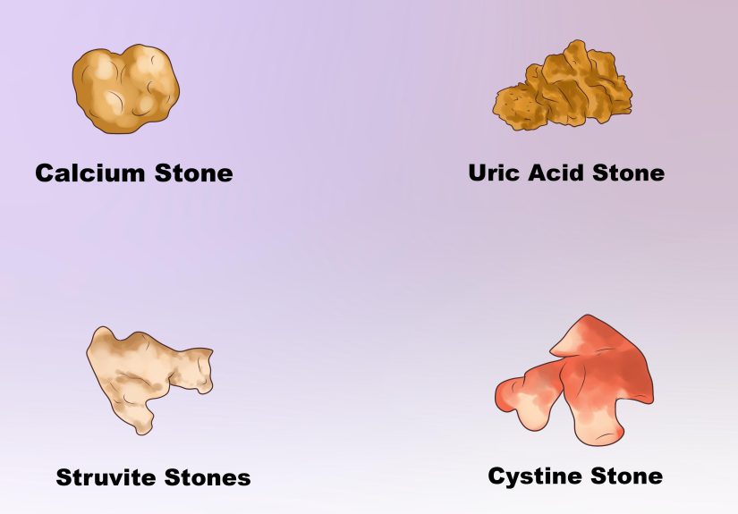 3 Ways to Dissolve Kidney Stones