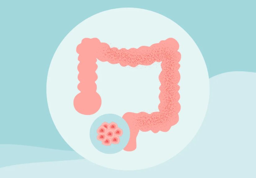 8 Colon Cancer Myths Debunked: Prevention and Early Detection Tips