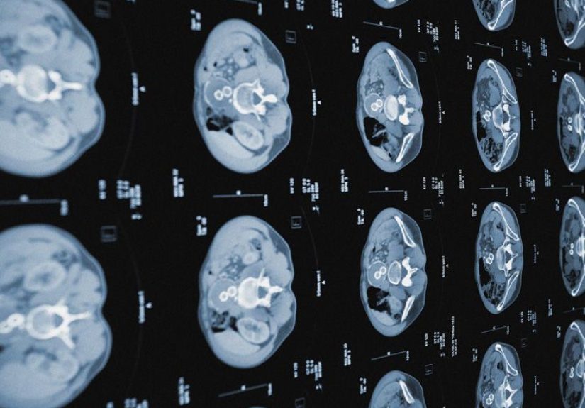 Cirrhosis of the liver life expectancy: Stages, outlook, and more
