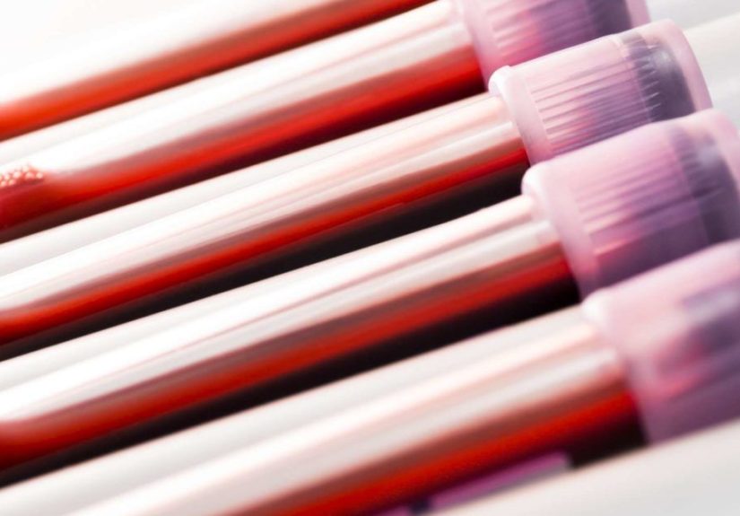 Epstein-Barr virus test: Procedure, results, and interpretation