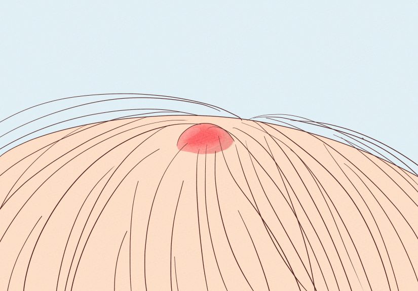 How to Check for and Identify Head Lice: Nurse-Reviewed Advice