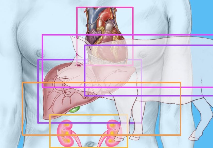 Recipient of First Genetically Modified Pig Heart Transplant Dies