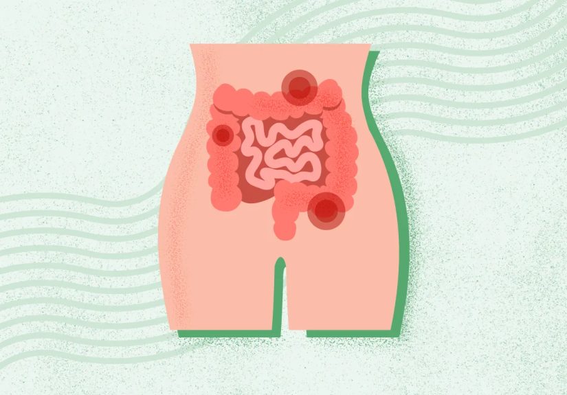 What Is Constipation? Symptoms, Causes, Diagnosis, Treatment, and Prevention