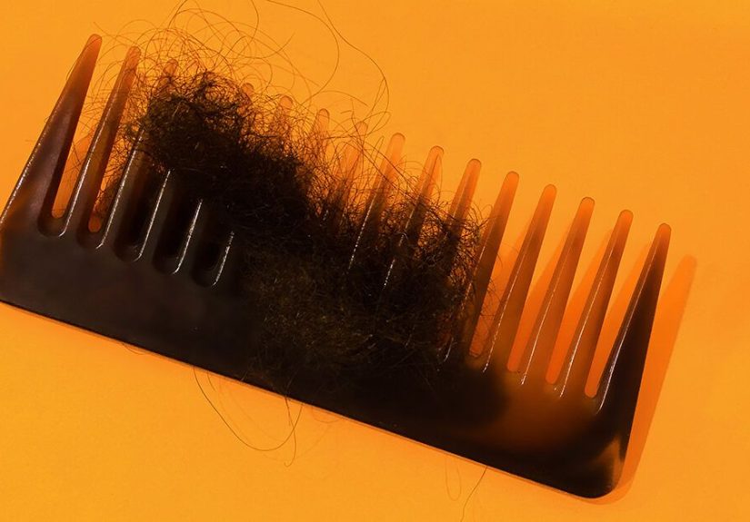 Are Stress and Hair-Loss Related?