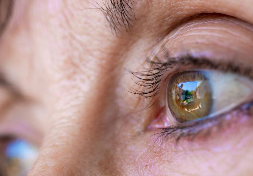 Melanoma in the Eye: Symptoms, Causes, Diagnosis, Treatment