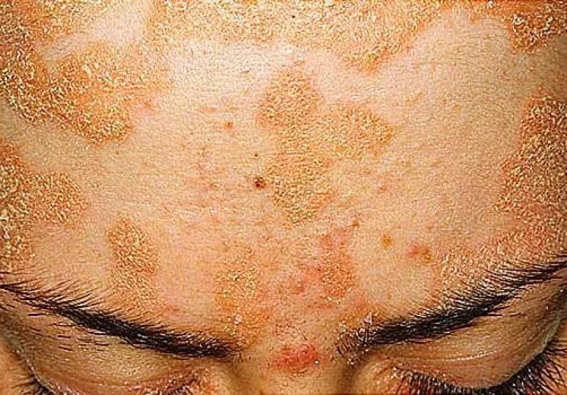 Pictures of Plaque Psoriasis, Pustular Psoriasis, and Other Types of Psoriasis