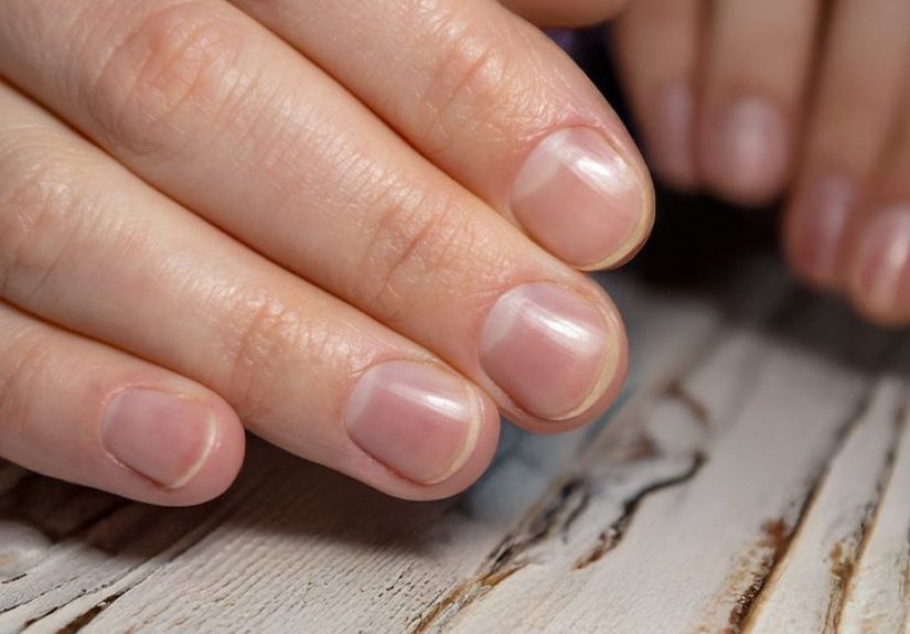 Half Moon Nails: Why You Do or Don’t Have It, Symptoms to Watch For