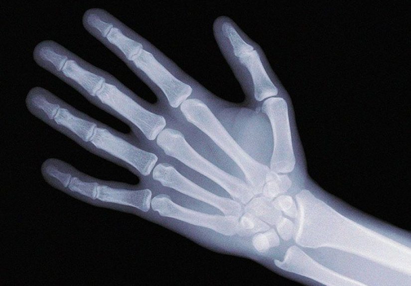 How Does a Bone Density Test Work and What Is It For?