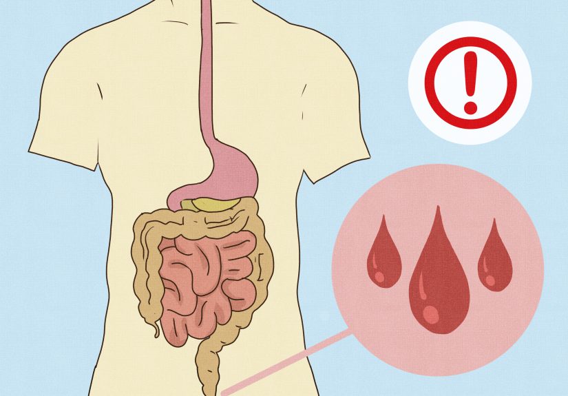 How to Perform at Enema at Home: Expert Tips