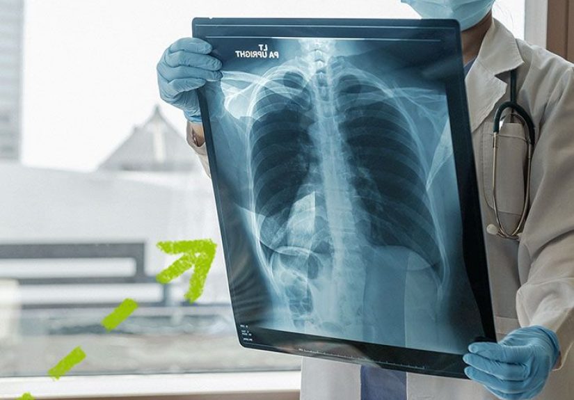 Pulmonary Fibrosis and Rheumatoid Arthritis: What Is the Link?