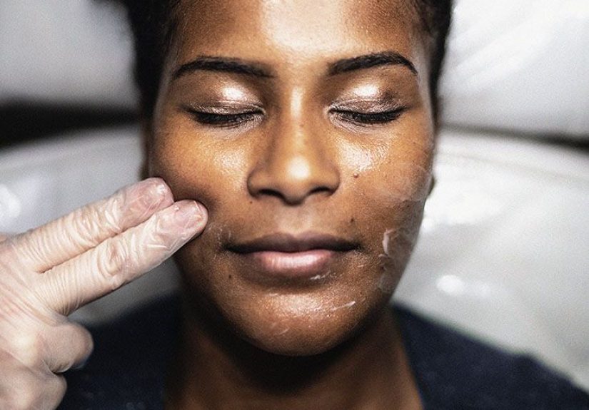 TCA Peel: Effectiveness, Safety, Cost, Results, and More