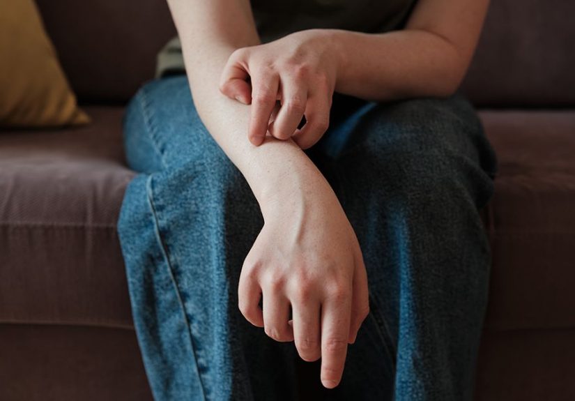 Urticarial Vasculitis: Symptoms, Causes, Treatment, and More